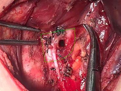 Clinical Relevance and Management of Recurrent Laryngeal Nerve Inlet Zone Lymph Nodes Metastasis in Papillary Thyroid Cancer